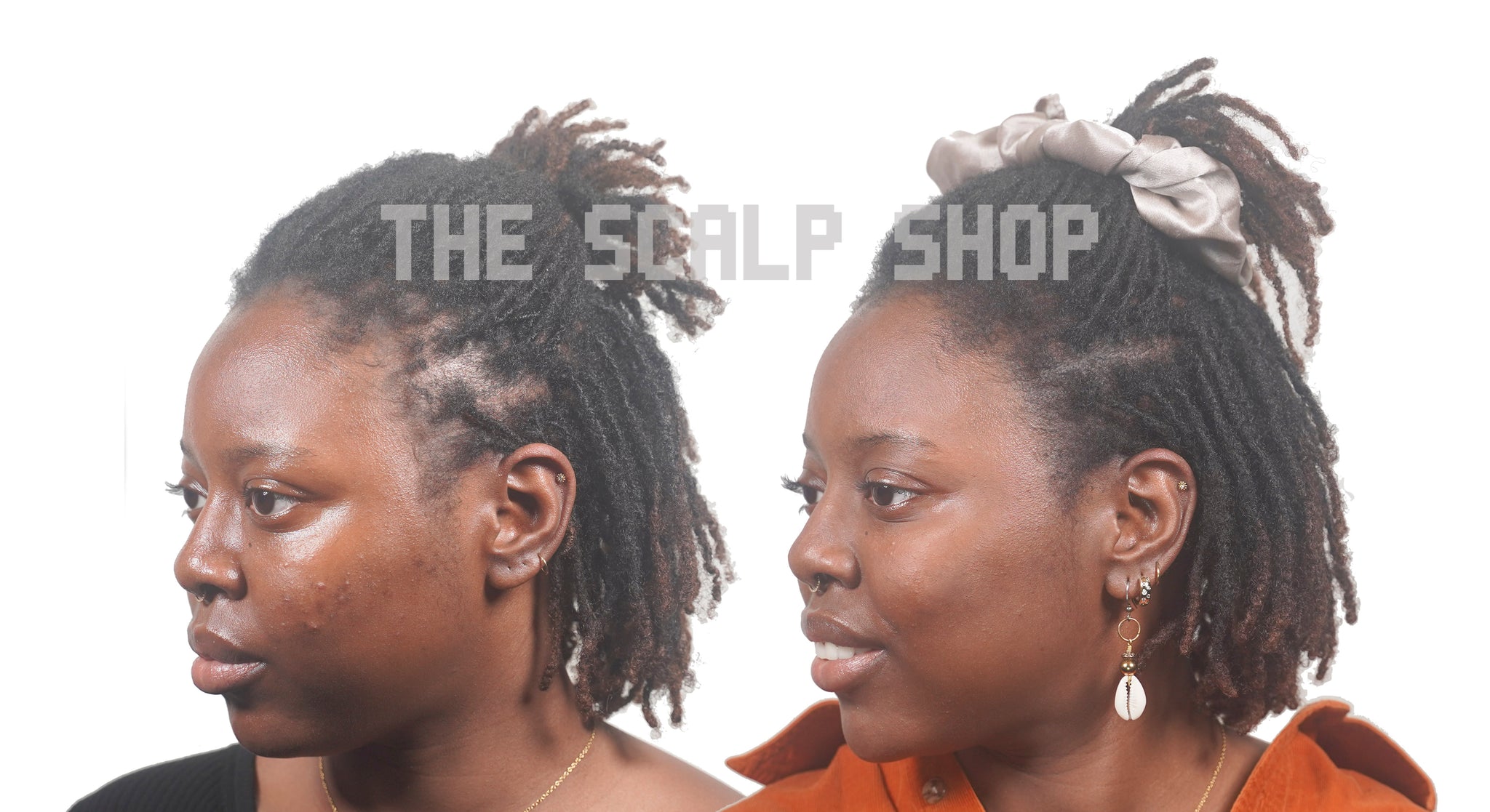 Scalp Micropigmentation (SMP) Hair Loss Treatment Non-Refundable Deposit - 2 Session Package
