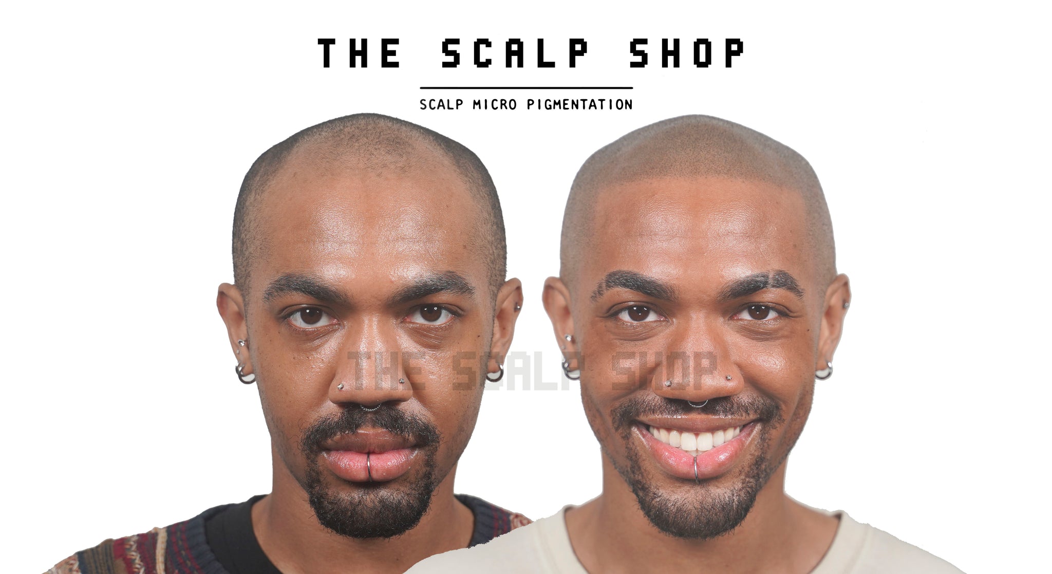 Scalp Micropigmentation (SMP) Hair Loss Treatment Non-Refundable Deposit - 2 Session Package