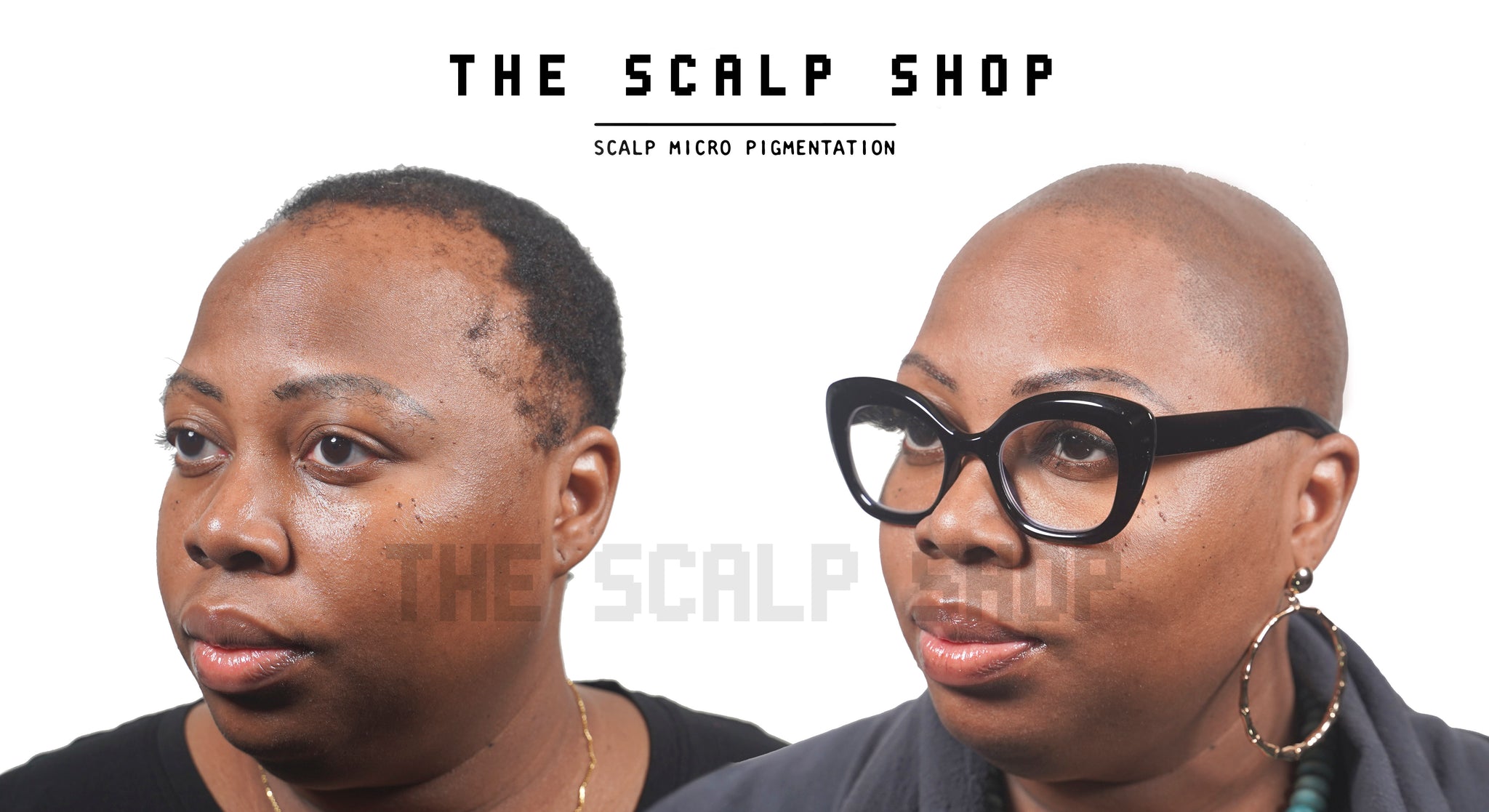 Scalp Micropigmentation (SMP) Hair Loss Treatment Non-Refundable Deposit - 2 Session Package