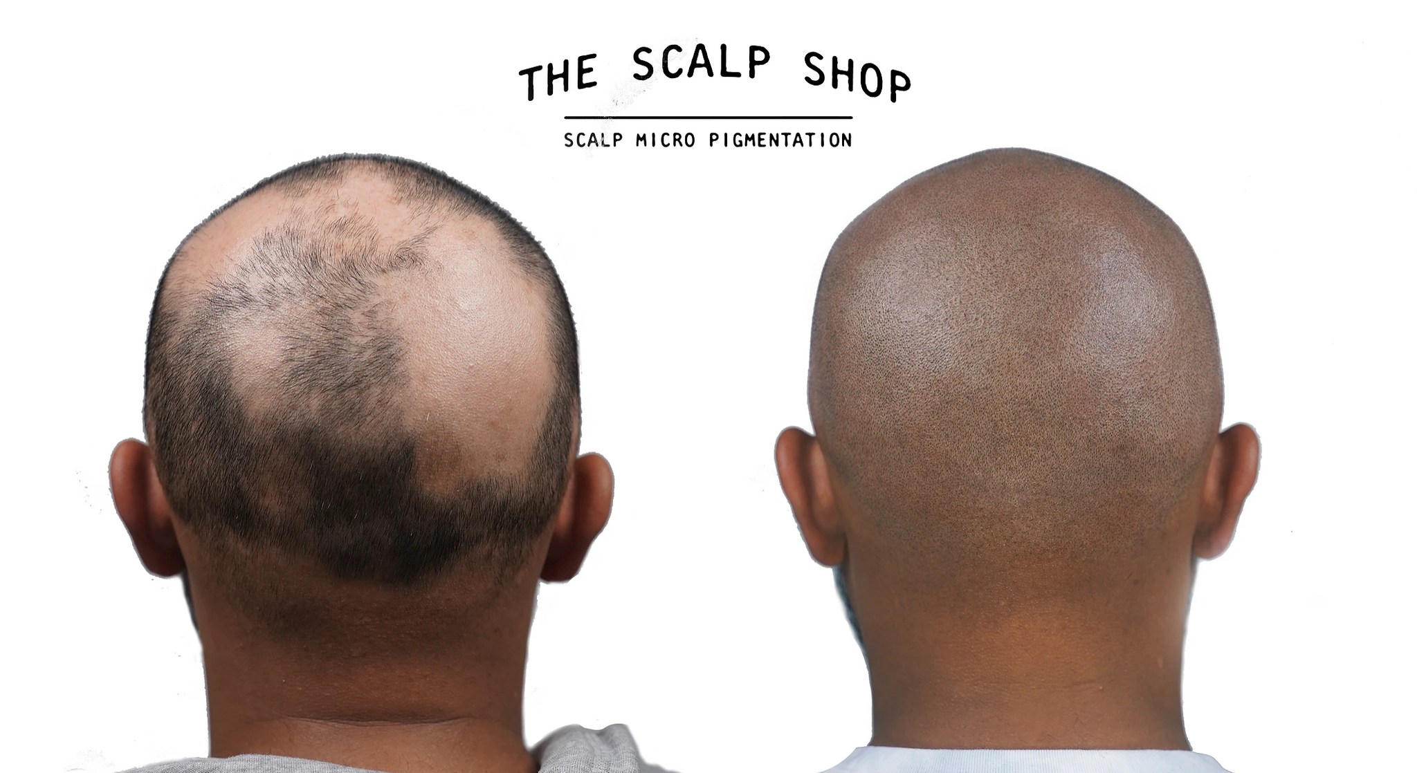 Scalp Micropigmentation (SMP) Hair Loss Treatment Non-Refundable Deposit - 2 Session Package