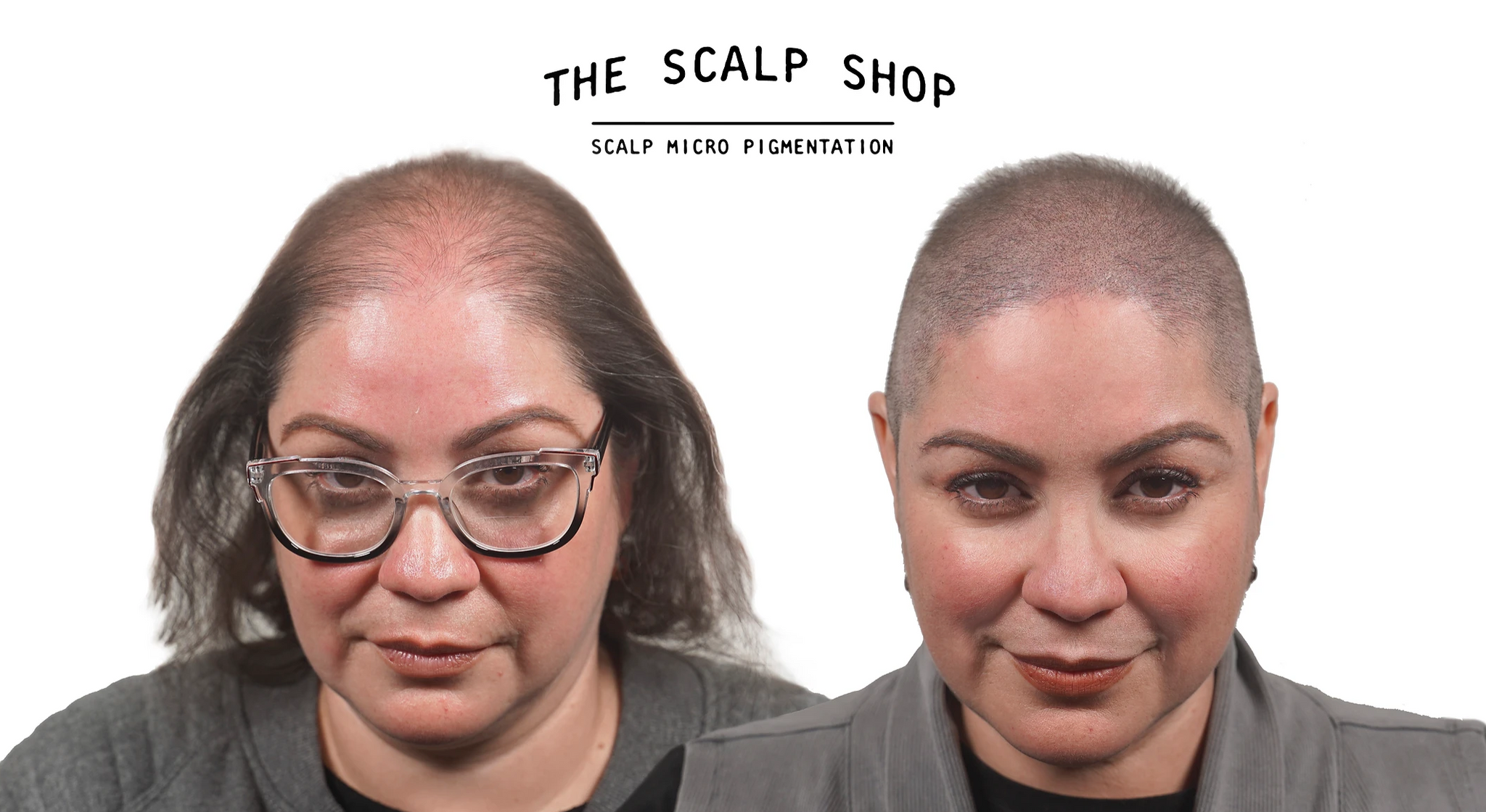 Scalp Micropigmentation (SMP) Hair Loss Treatment Non-Refundable Deposit - 2 Session Package