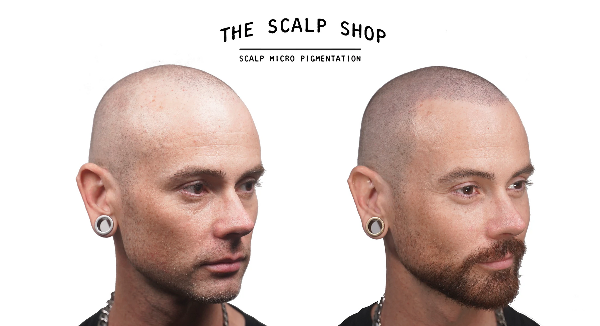 Scalp Micropigmentation (SMP) Hair Loss Treatment Non-Refundable Deposit - 2 Session Package