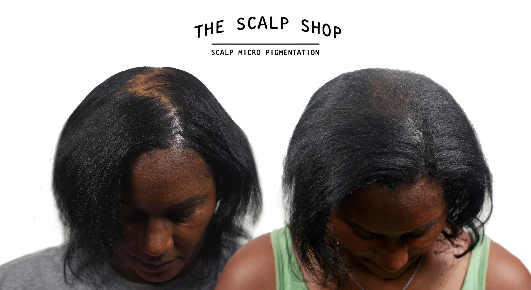 Scalp Micropigmentation (SMP) Hair Loss Treatment Non-Refundable Deposit - 2 Session Package