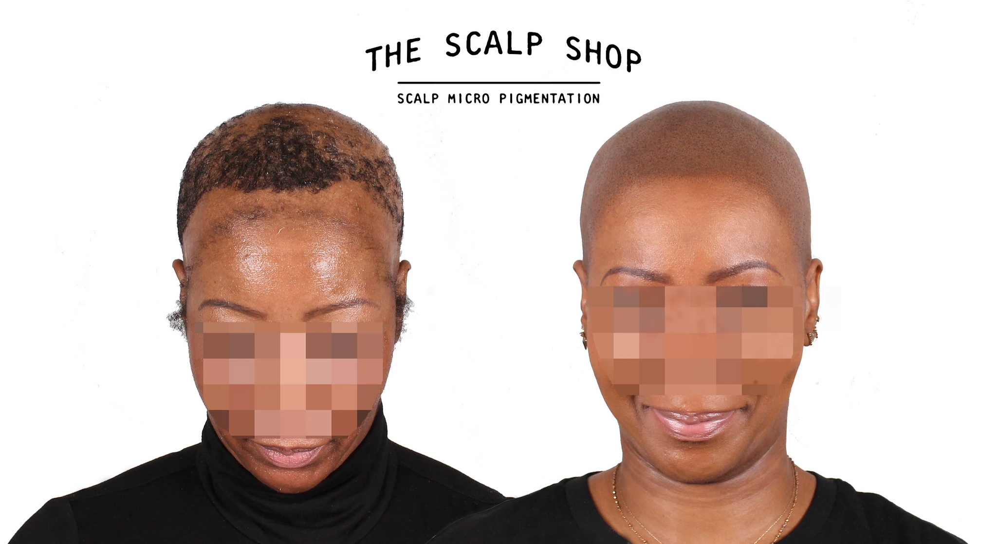 Scalp Micropigmentation (SMP) Hair Loss Treatment Non-Refundable Deposit - 2 Session Package